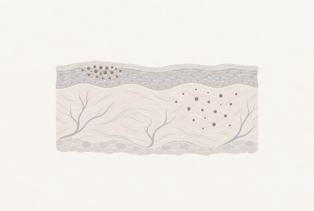 Skin cross-section: pigment gathered in the epidermis and pigment scattered in the dermis